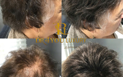 TÓC HÓI RỤNG TỪNG MẢNG LỚN CÓ SỬ DỤNG PHƯƠNG PHÁP CẤY TẠI DR4 YOU ĐƯỢC HAY KHÔNG?
