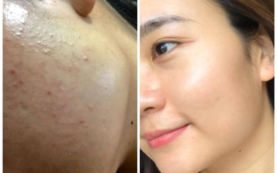 Điều Trị Mụn Uy Tín Quận 2