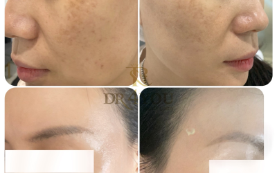 Điều Trị Nám Uy Tín Quận 2 – DR4You Beauty Center