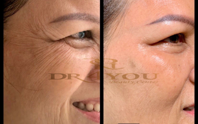 Trẻ Hóa Da Công Nghệ Cao Hiệu Quả Tại Dr4You – Bác Sĩ Da Liễu Uy Tín