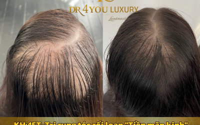 Chi Phí Cấy Tóc Tự Thân Tại DR4YOU – Bao Nhiêu Là Đủ?