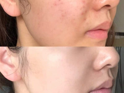Trị Mụn Da